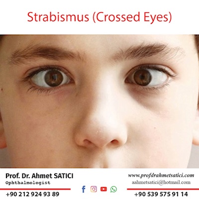 Strabismus (Crossed Eyes) 