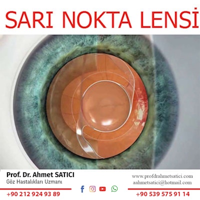 Scharioth Macula Lens (Age-related Macular Degeneration Lens)