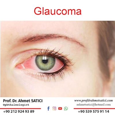 Glaucoma