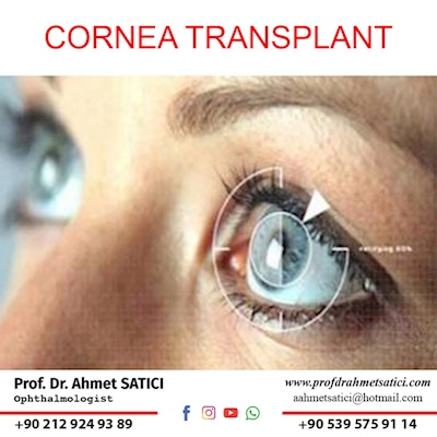 Cornea Transplant